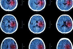 Ct Scan Of Brain With Red Area ( Imaging For Hemorrhagic Stroke